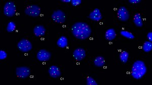 Image of breast cancer cells.