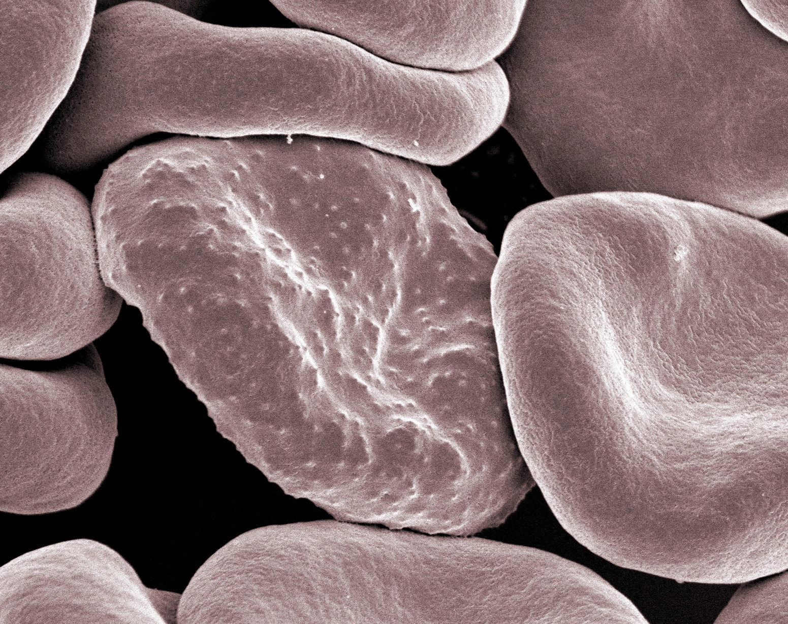 Electron micrograph shows a group of bialy-like red blood cells. The central cell is covered in many small bumps, evidence of its malaria infection.